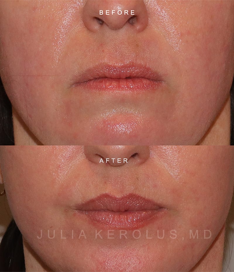 Lip fillers Before & After Image