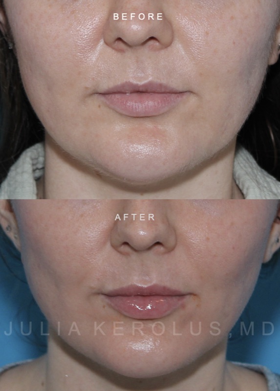 Lip fillers Before & After Image
