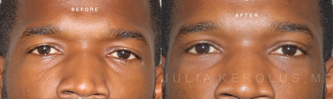 Blepharoplasty Before & After Image