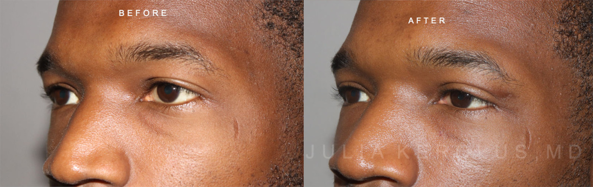 Blepharoplasty Before & After Image
