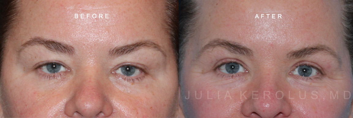 Blepharoplasty Before & After Image