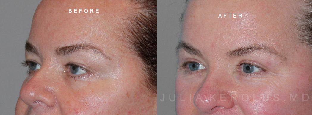 Blepharoplasty Before & After Image