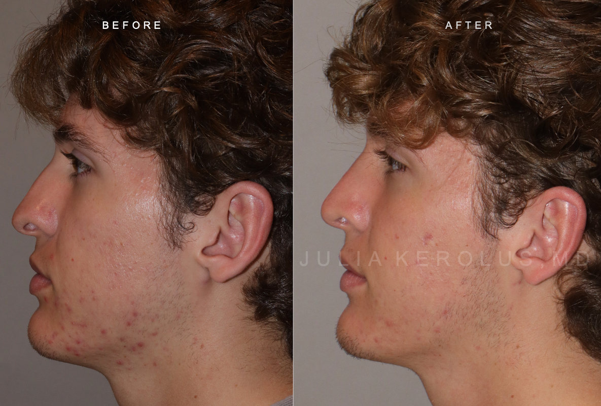 Rhinoplasty Before & After Image