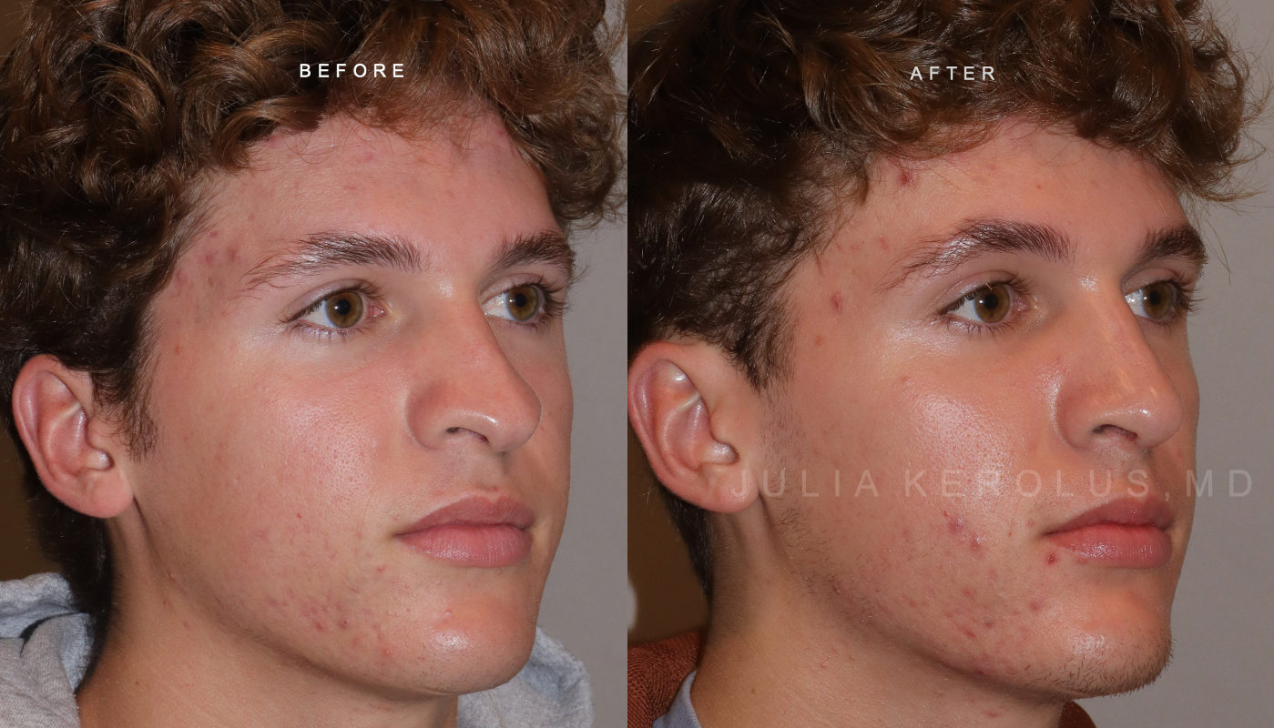 Rhinoplasty Before & After Image