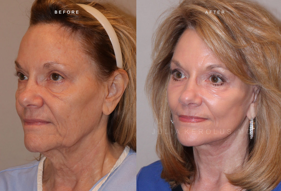 CO2 Laser Before & After Image
