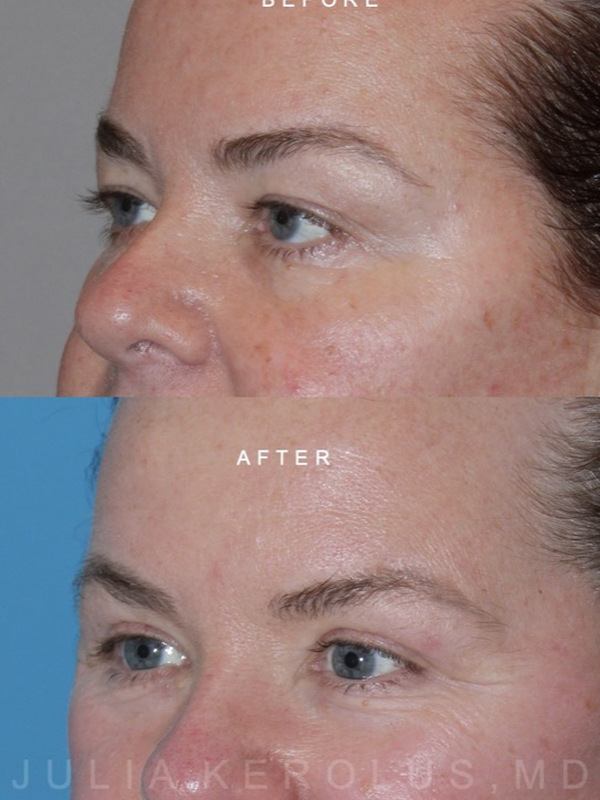 Browlift/Blepharoplasty Before & After Image