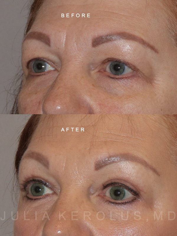 Browlift/Blepharoplasty Before & After Image
