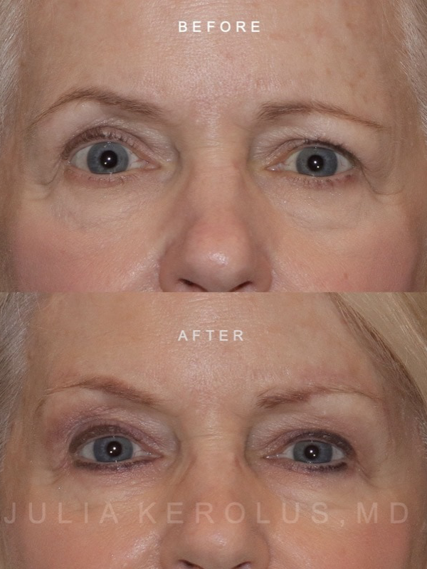 Blepharoplasty Before & After Image