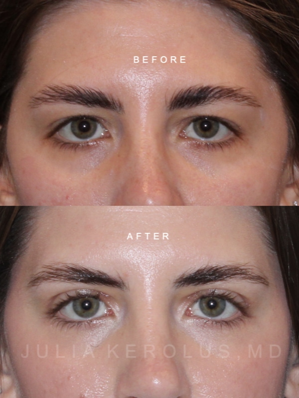 Blepharoplasty Before & After Image