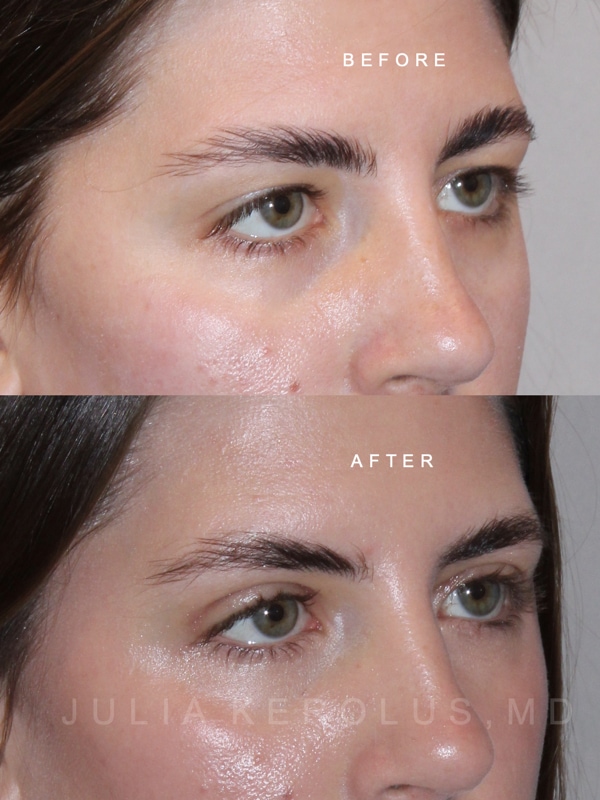 Blepharoplasty Before & After Image