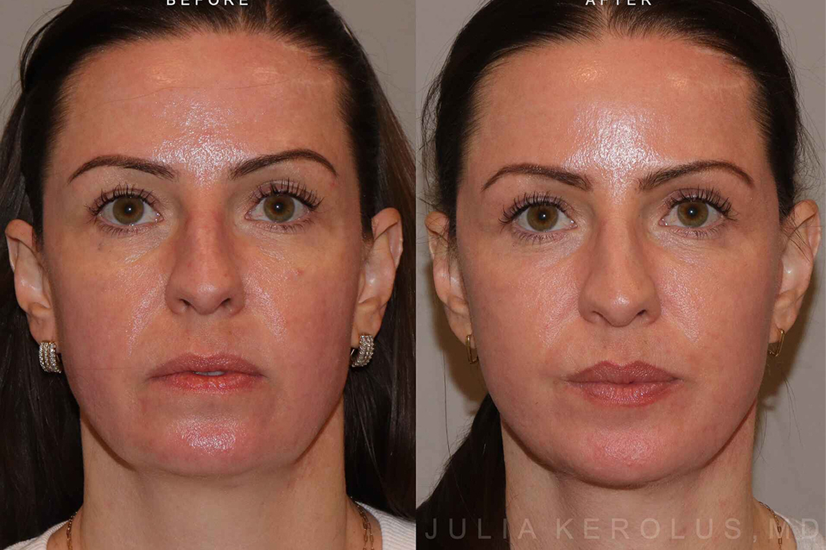 Deep Plane Facelift/Neck Lift Before & After Image