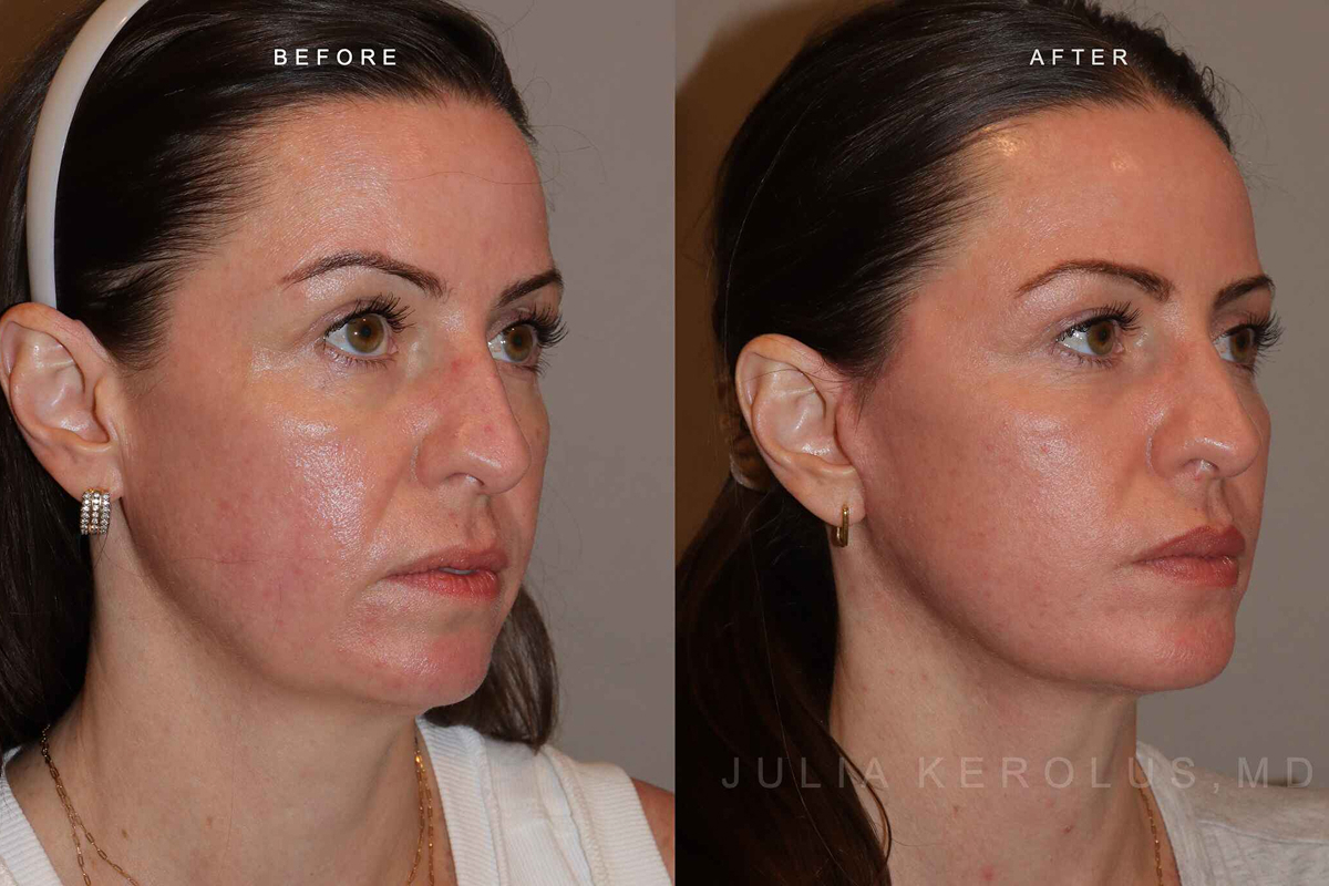 Deep Plane Facelift/Neck Lift Before & After Image
