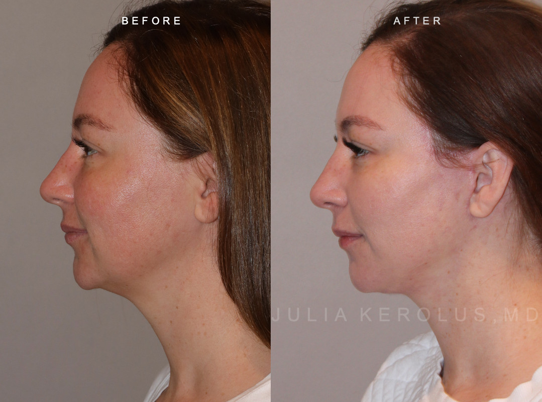 Deep Plane Facelift/Neck Lift Before & After Image
