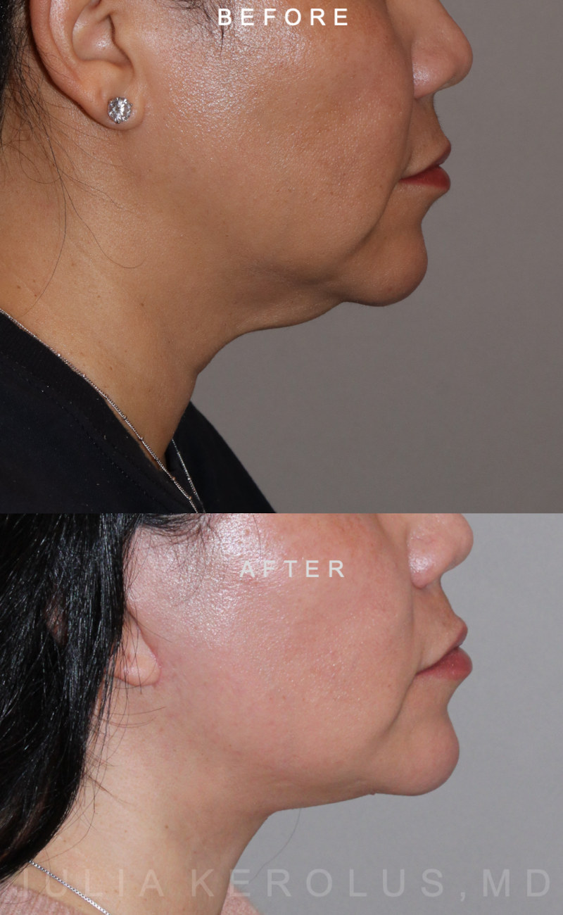 Deep Plane Facelift/Neck Lift Before & After Image