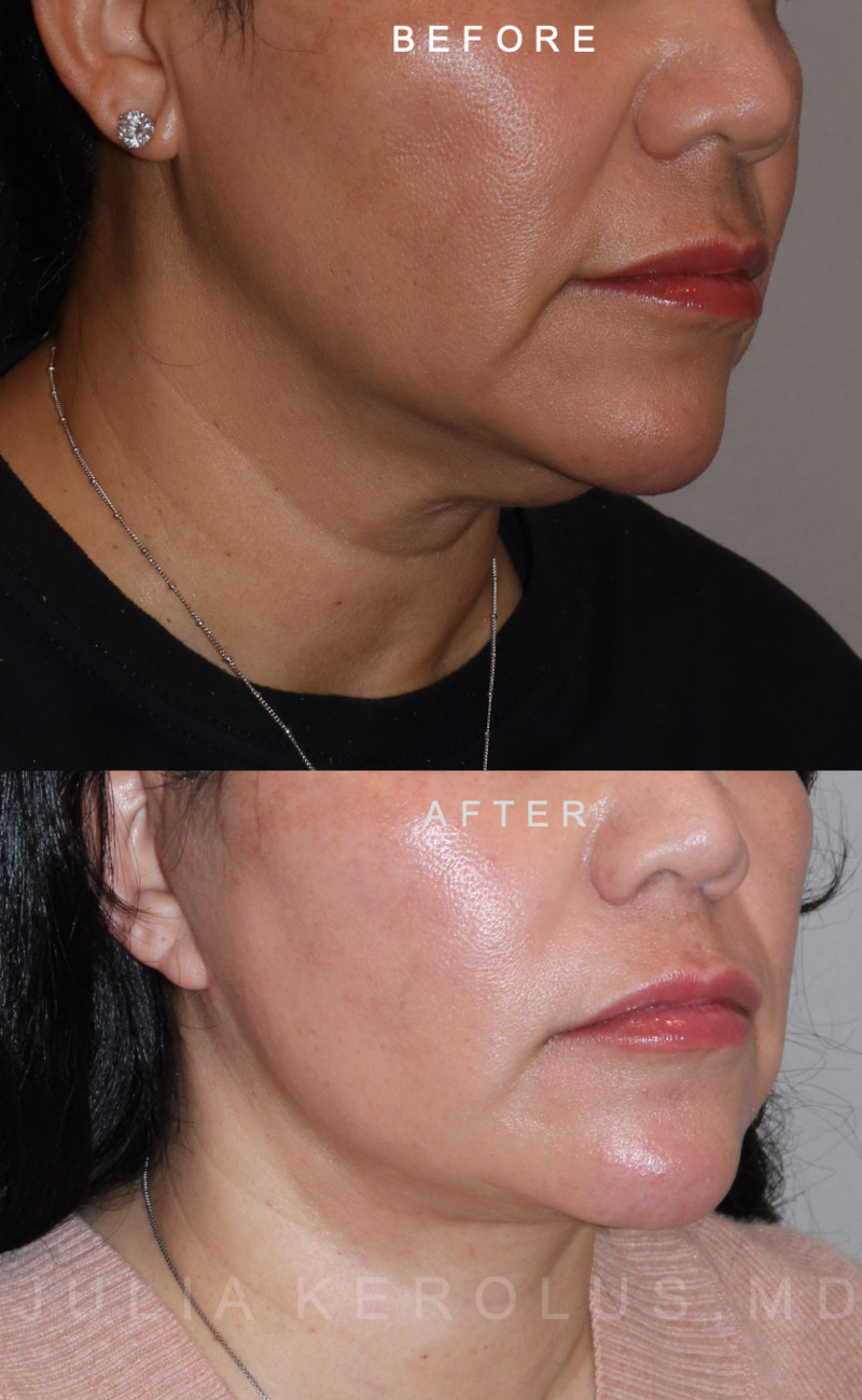 Deep Plane Facelift/Neck Lift Before & After Image