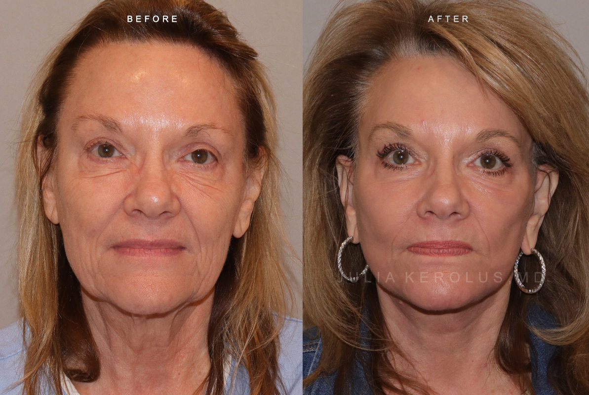 Deep Plane Facelift/Neck Lift Before & After Image