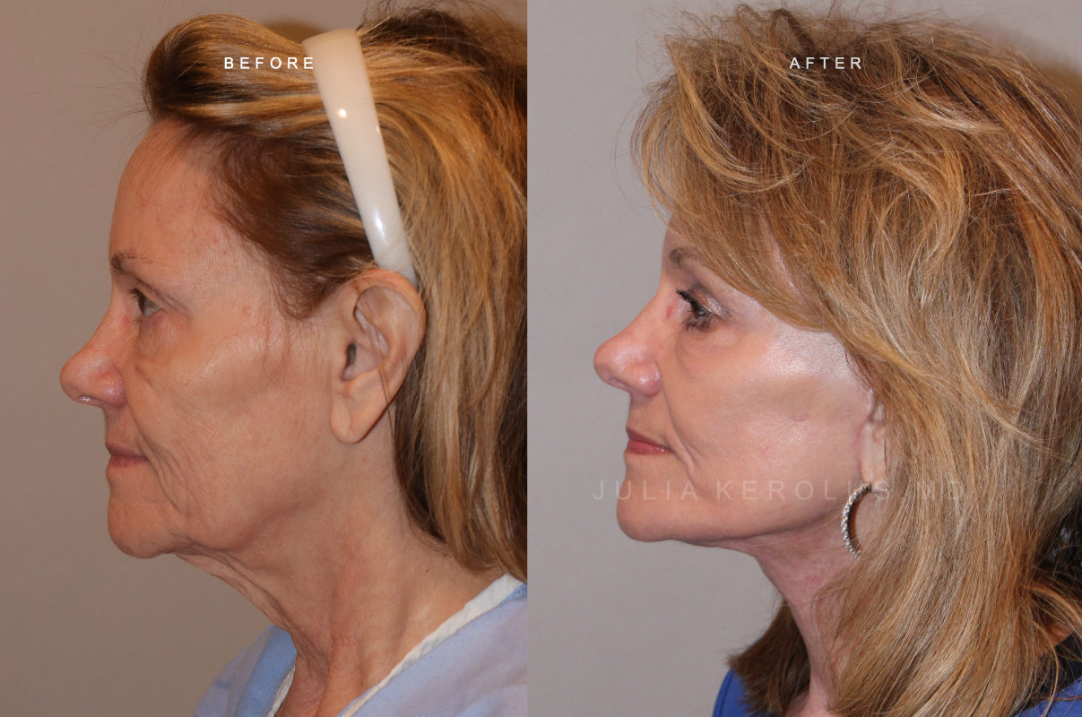 Deep Plane Facelift/Neck Lift Before & After Image