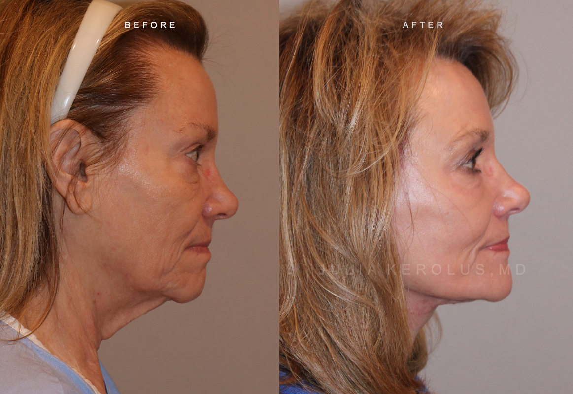Deep Plane Facelift/Neck Lift Before & After Image