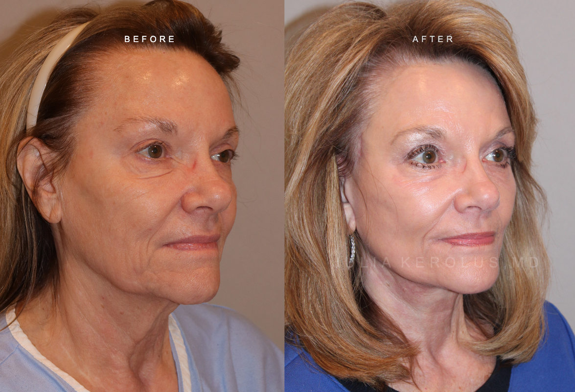 Deep Plane Facelift/Neck Lift Before & After Image
