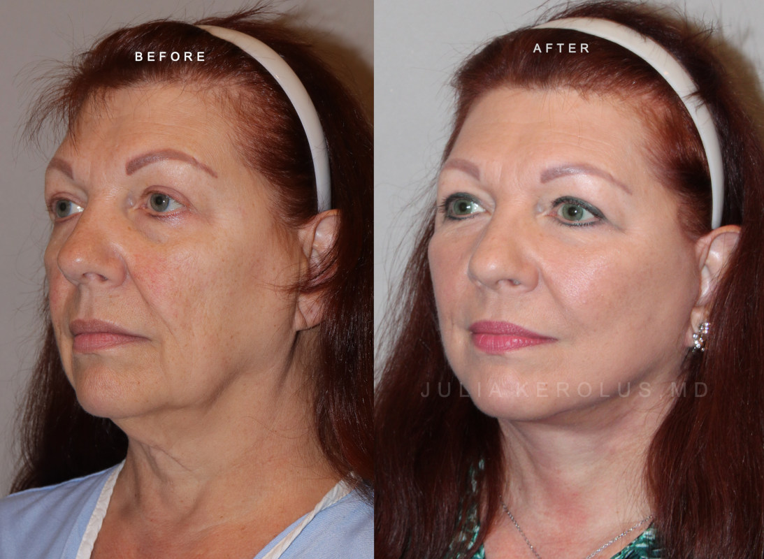 Deep Plane Facelift/Neck Lift Before & After Image