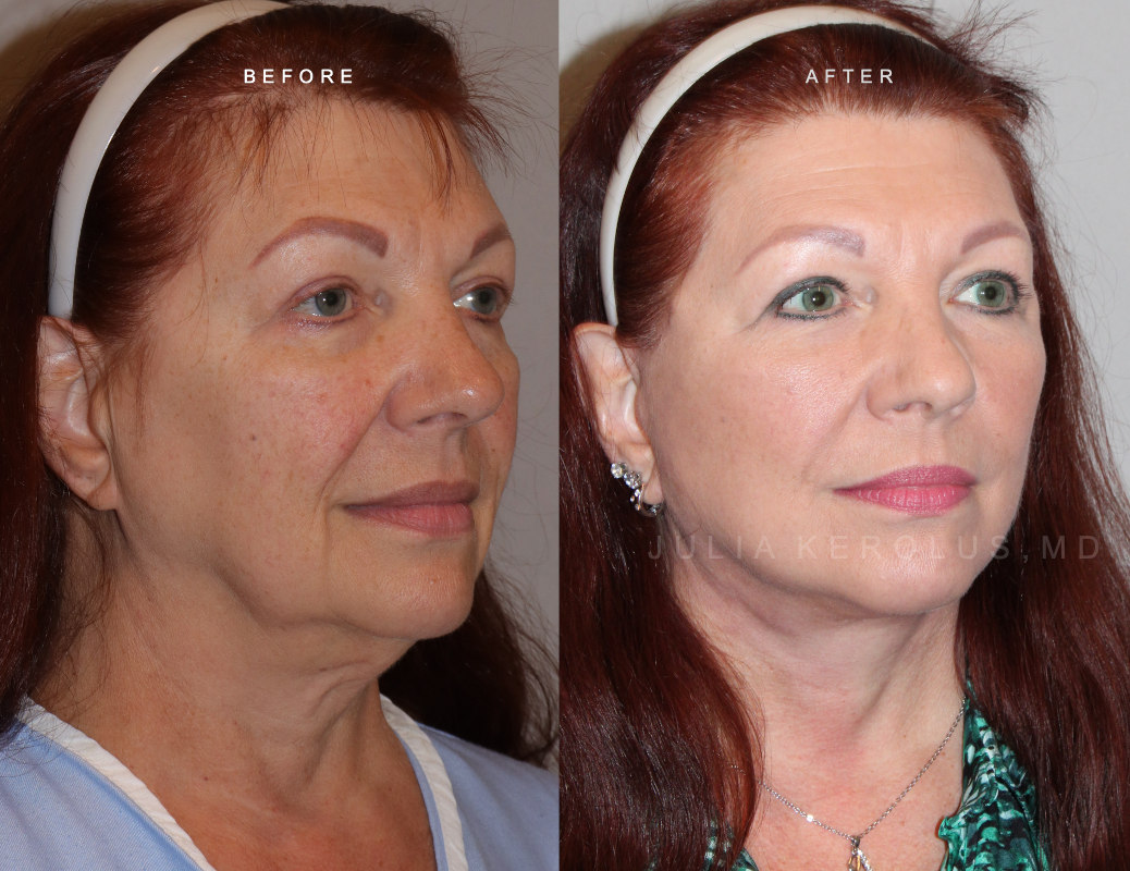 Deep Plane Facelift/Neck Lift Before & After Image