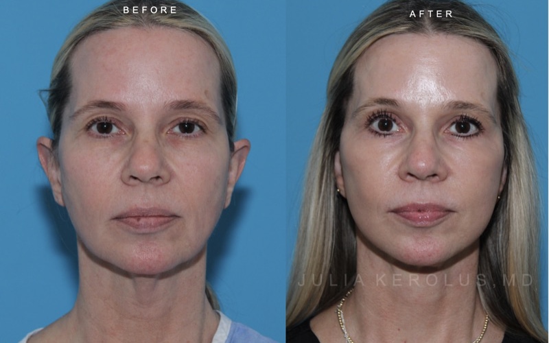 Deep Plane Facelift/Neck Lift Before & After Image