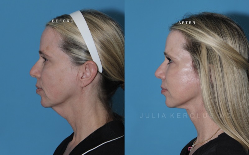 Deep Plane Facelift/Neck Lift Before & After Image