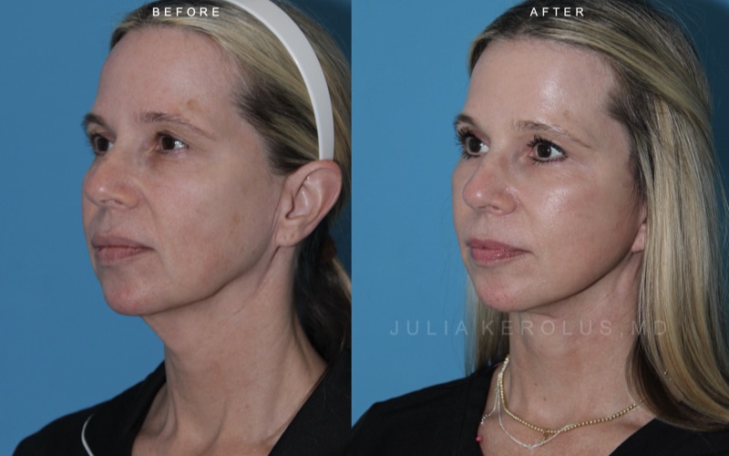 Deep Plane Facelift/Neck Lift Before & After Image