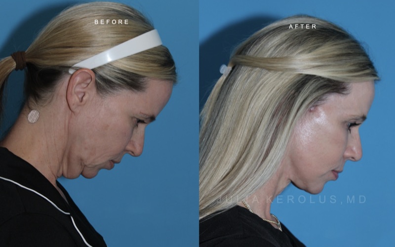 Deep Plane Facelift/Neck Lift Before & After Image