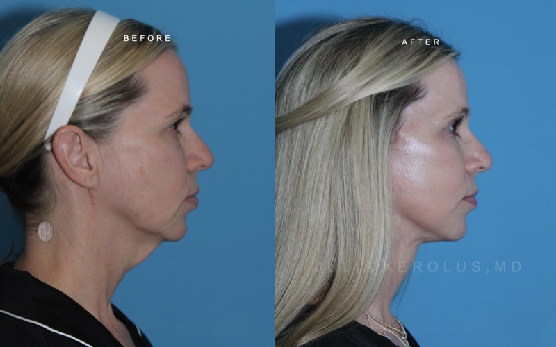 Deep Plane Facelift/Neck Lift Before & After Image