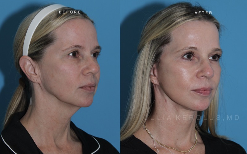 Deep Plane Facelift/Neck Lift Before & After Image