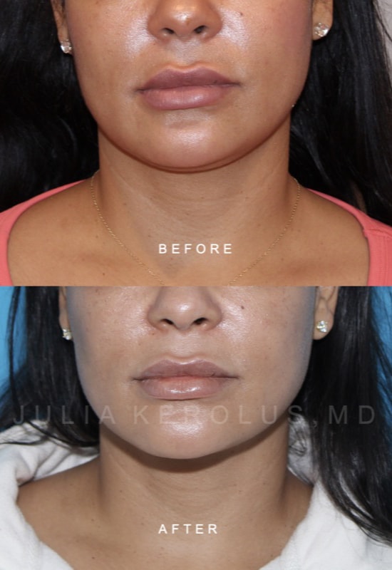 Facial Contouring / Jawline Liposuction Before & After Image