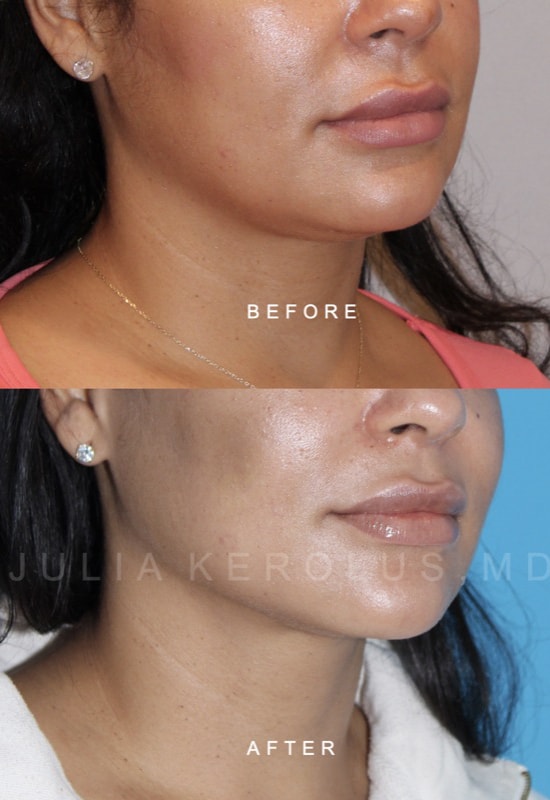 Facial Contouring / Jawline Liposuction Before & After Image