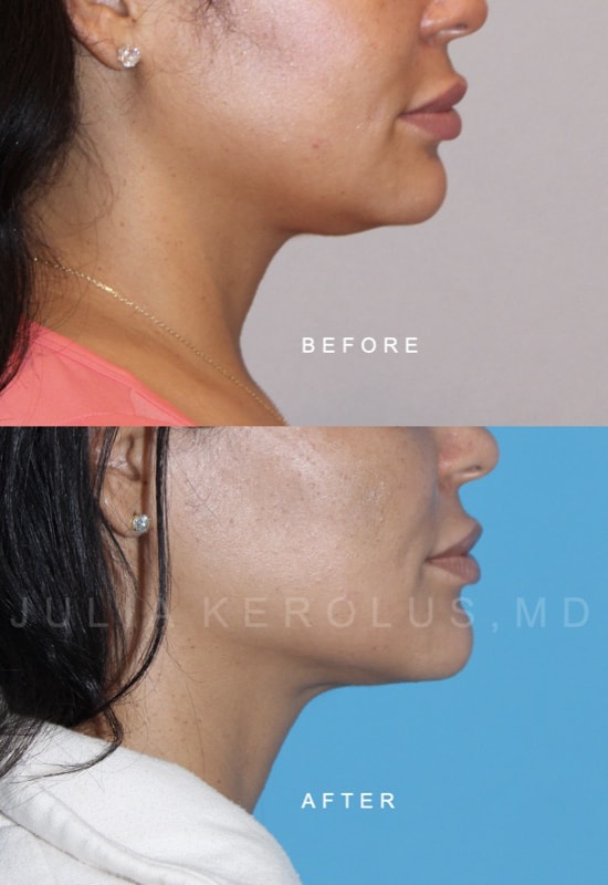 Facial Contouring / Jawline Liposuction Before & After Image