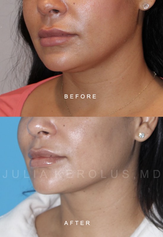 Facial Contouring / Jawline Liposuction Before & After Image