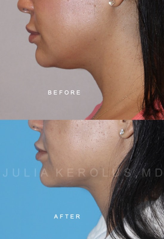 Facial Contouring / Jawline Liposuction Before & After Image