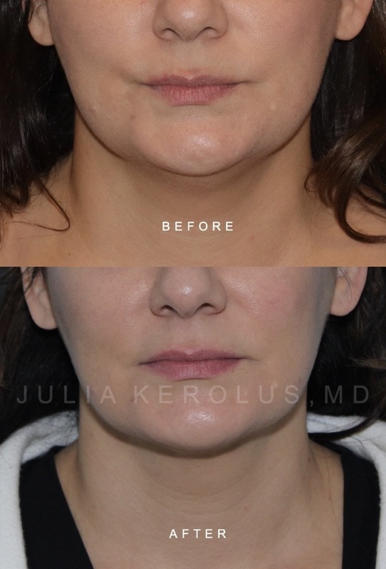 Facial Contouring / Jawline Liposuction Before & After Image