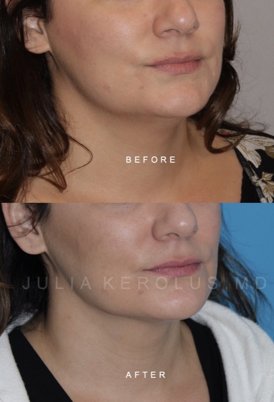 Facial Contouring / Jawline Liposuction Before & After Image