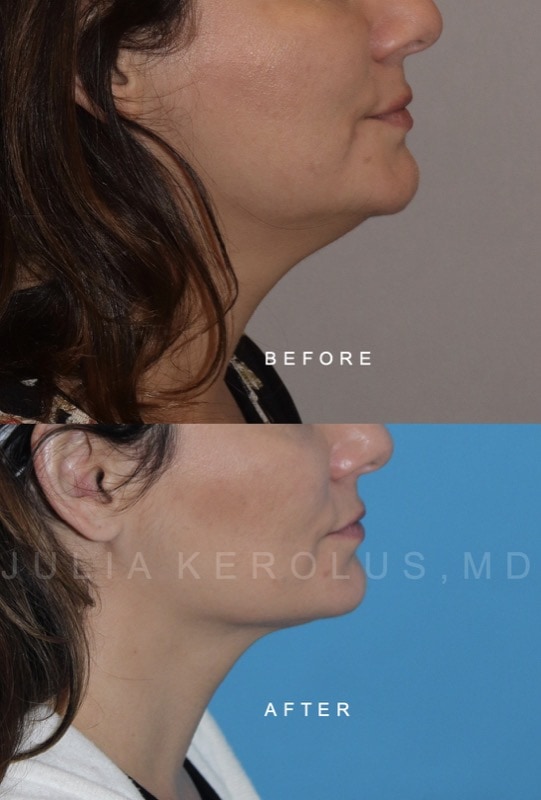 Facial Contouring / Jawline Liposuction Before & After Image