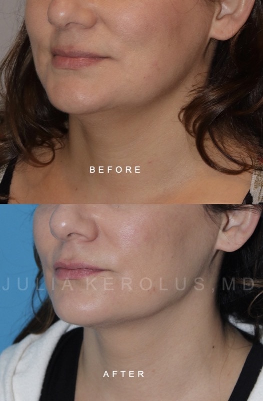 Facial Contouring / Jawline Liposuction Before & After Image