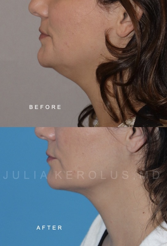 Facial Contouring / Jawline Liposuction Before & After Image
